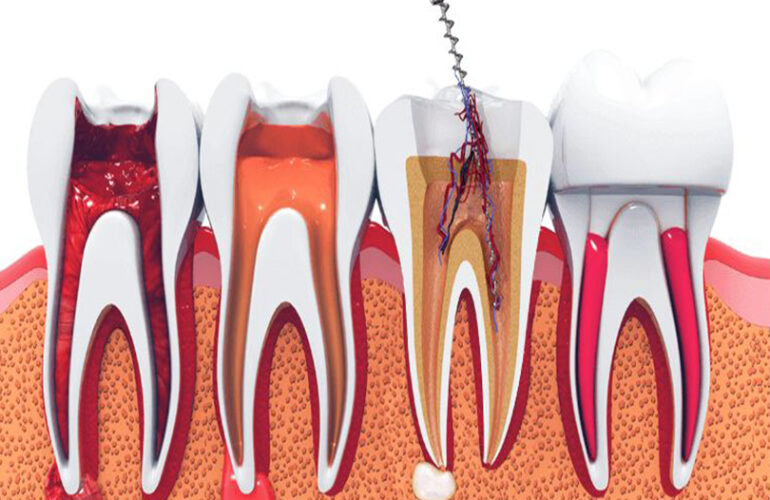 root canal treatment in calicut