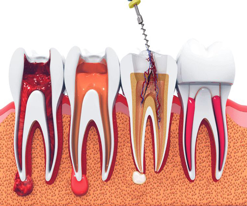 root canal treatment in calicut